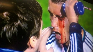 Xem ra Ronaldo vẫn còn .... may chán khi chỉ bị rách mắt!
