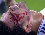 Pepe dính chấn thương nặng ở đầu