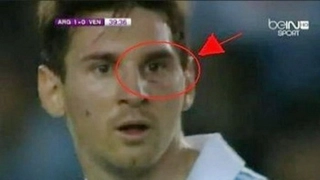 Messi bị chơi xấu bầm tím cả mặt