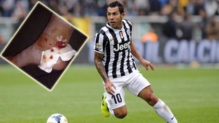 Tevez khoe mắt cá be bét sau derby Turin