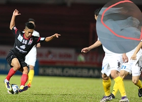 Cầu thủ Việt phải ghép gân vai vì pha bóng bạo lực