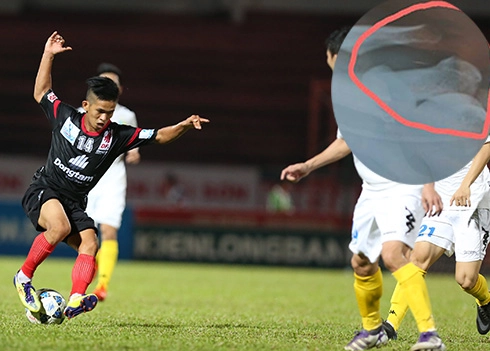 Cầu thủ Việt phải ghép gân vai vì pha bóng bạo lực